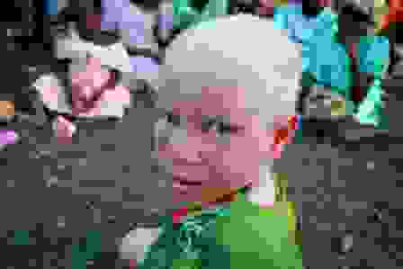 0albino